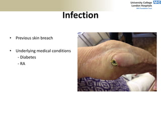 Infection
• Previous skin breach
• Underlying medical conditions
- Diabetes
- RA
 
