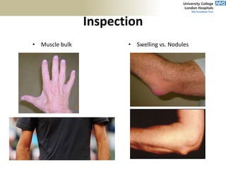 Inspection
• Muscle bulk • Swelling vs. Nodules
 