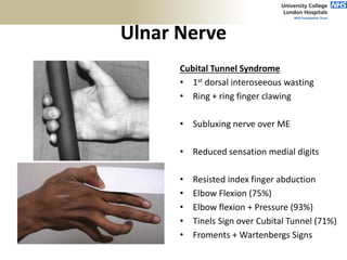 Ulnar Nerve
Cubital Tunnel Syndrome
• 1st dorsal interoseeous wasting
• Ring + ring finger clawing
• Subluxing nerve over ME
• Reduced sensation medial digits
• Resisted index finger abduction
• Elbow Flexion (75%)
• Elbow flexion + Pressure (93%)
• Tinels Sign over Cubital Tunnel (71%)
• Froments + Wartenbergs Signs
 