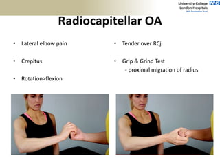 Radiocapitellar OA
• Lateral elbow pain
• Crepitus
• Rotation>flexion
• Tender over RCj
• Grip & Grind Test
- proximal migration of radius
 