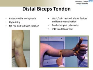 Distal Biceps Tendon
• Anteromedial ecchymosis
• High riding
• No rise and fall with rotation
• Weak/pain resisted elbow flexion
and forearm supination
• Tender biciptal tuberosity
• O’Driscoll Hook Test
 