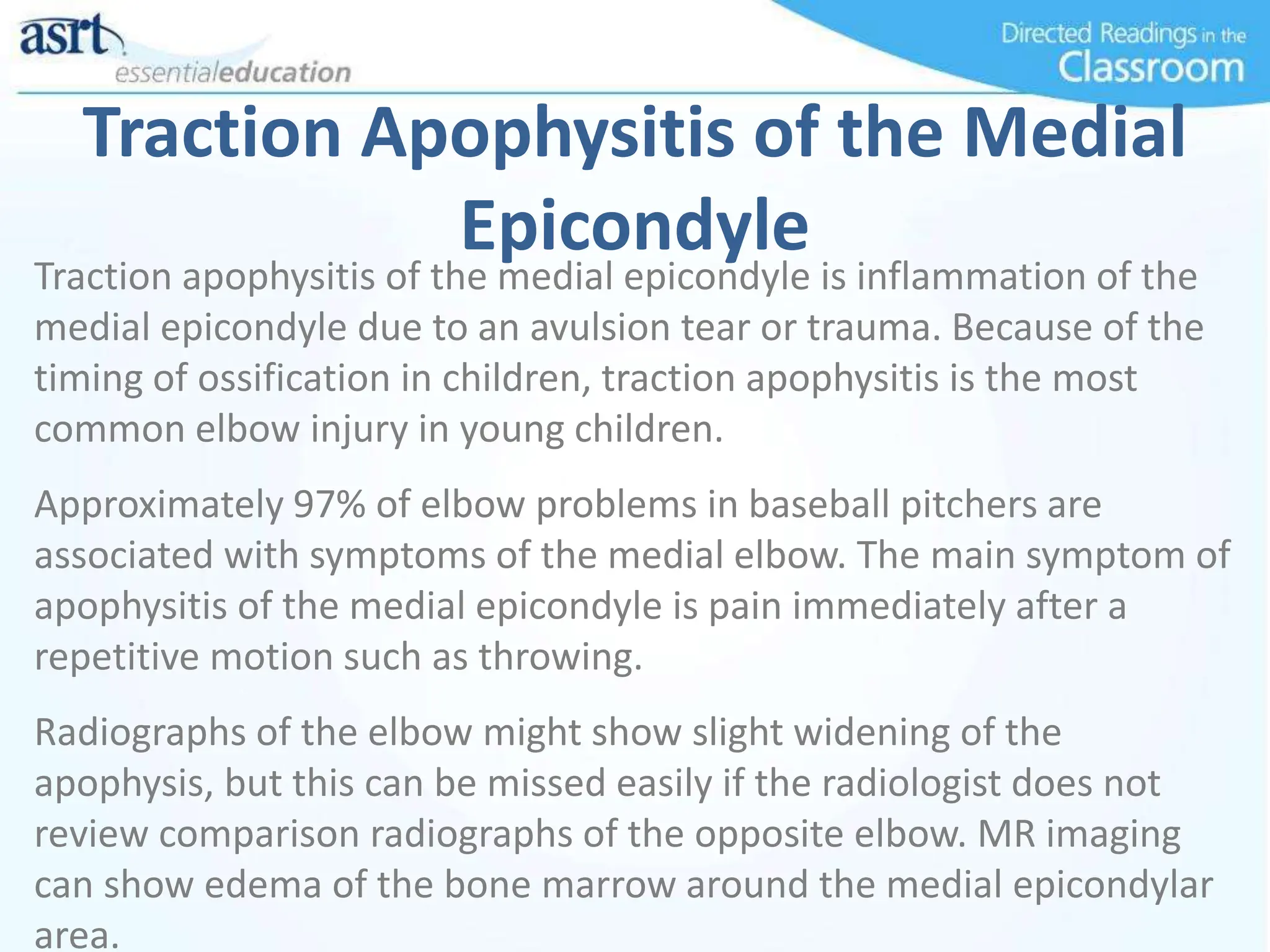 Traction Apophysitis of the Medial
Epicondyle
Traction apophysitis of the medial epicondyle is inflammation of the
medial epicondyle due to an avulsion tear or trauma. Because of the
timing of ossification in children, traction apophysitis is the most
common elbow injury in young children.
Approximately 97% of elbow problems in baseball pitchers are
associated with symptoms of the medial elbow. The main symptom of
apophysitis of the medial epicondyle is pain immediately after a
repetitive motion such as throwing.
Radiographs of the elbow might show slight widening of the
apophysis, but this can be missed easily if the radiologist does not
review comparison radiographs of the opposite elbow. MR imaging
can show edema of the bone marrow around the medial epicondylar
area.
 