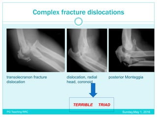 Complex Dislocation Elbow trauma & infection | PPTX