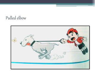 Pulled elbow
 