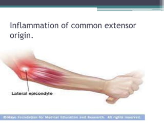 Inflammation of common extensor
origin.
 