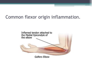 Common flexor origin inflammation.
 