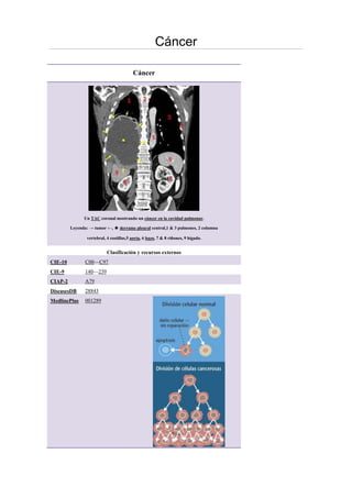 Cáncer
Cáncer
Un TAC coronal mostrando un cáncer en la cavidad pulmonar.
Leyenda: → tumor ←, ★ derrame pleural central,1 & 3 pulmones, 2 columna
vertebral, 4 costillas,5 aorta, 6 bazo, 7 & 8 riñones, 9 hígado.
Clasificación y recursos externos
CIE-10 C00—C97
CIE-9 140—239
CIAP-2 A79
DiseasesDB 28843
MedlinePlus 001289
 