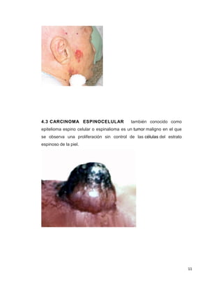 11
4.3 CARCINOMA ESPINOCELULAR también conocido como
epitelioma espino celular o espinalioma es un tumor maligno en el que
se observa una proliferación sin control de las células del estrato
espinoso de la piel.
 