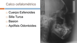 Calco cefalométrico

   Cuerpo Esfenoides
   Silla Turca
   Basion
   Apófisis Odontoides
 