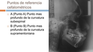 Puntos de referencia
cefalométricos
   A (Punto A) Punto mas
    profundo de la curvatura
    subespinal
   B (Punto B) Punto mas
    profundo de la curvatura
    supramentoniana
 