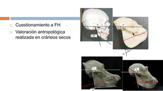    Cuestionamiento a FH
   Valoración antropológica
    realizada en cráneos secos
 
