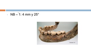 •   NB – 1: 4 mm y 25°
 