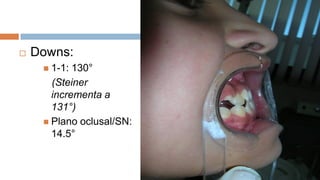    Downs:
      1-1: 130°
       (Steiner
       incrementa a
       131°)
      Plano oclusal/SN:
       14.5°
 