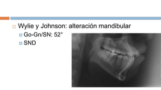    Wylie y Johnson: alteración mandibular
     Go-Gn/SN:   52°
     SND
 