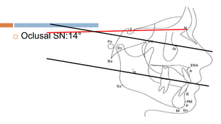    Oclusal SN:14°
 