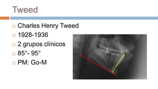 Tweed
   Charles Henry Tweed
   1928-1936
   2 grupos clínicos
   85°- 95°
   PM: Go-M
 