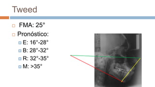 Tweed
   FMA: 25°
   Pronóstico:
     E: 16°-28°
     B: 28°-32°

     R: 32°-35°

     M: >35°
 