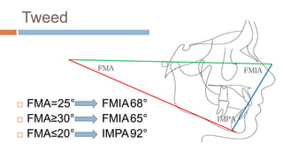Tweed


              FMA               FMIA



   FMA=25°   FMIA68°
   FMA≥30°   FMIA65°    IMPA

   FMA≤20°   IMPA 92°
 