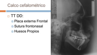 Calco cefalométrico

   TT DD:
     Placa externa Frontal
     Sutura frontonasal

     Huesos Propios
 