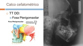Calco cefalométrico

   TT DD:
     Fosa   Pterigomaxilar
 
