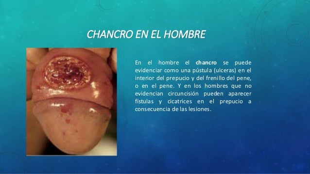 Fotos de ulceras en el pene 73 Fotos de ulceras en el pene 54