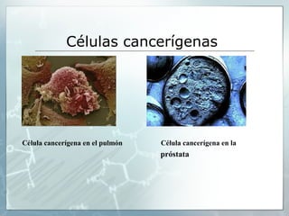 Células cancerígenas
Célula cancerígena en el pulmón Célula cancerígena en la
próstata
 
