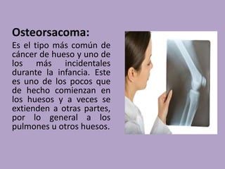 Osteorsacoma:
Es el tipo más común de
cáncer de hueso y uno de
los más incidentales
durante la infancia. Este
es uno de los pocos que
de hecho comienzan en
los huesos y a veces se
extienden a otras partes,
por lo general a los
pulmones u otros huesos.
 