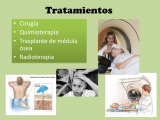 Tratamientos
• Cirugía
• Quimioterapia
• Trasplante de médula
ósea
• Radioterapia
 