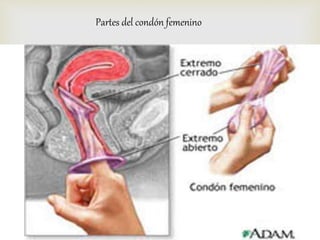 Partes del condón femenino 
 
