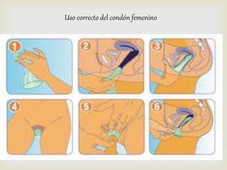Uso correcto del condón femenino 
 