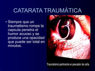 CATARATA TRAUMÁTICA
• Siempre que un
traumatismo rompe la
capsula penetra el
humor acuoso y se
produce una opacidad
que puede ser total en
minutos.
 