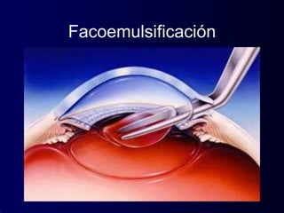 Facoemulsificación
 