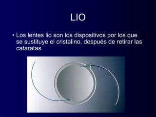 LIO
• Los lentes lio son los dispositivos por los que
se sustituye el cristalino, después de retirar las
cataratas.
 
