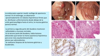 La endoscopia superior reveló: esófago de apariencia
normal. En el estómago, se observaron
aproximadamente 15 nódulos hiperémicos firmes que
se distribuían uniformemente desde debajo de la
unión gastroesofágica hasta el antro, la mucosa gástrica
parecía normal.
La primera y segunda parte del duodeno mostraron
vellosidades y mucosas normales.
En la tercera parte del duodeno, había lesiones
adicionales que tenían la misma apariencia hiperémica
pero eran más arquitectónicamente
planas que sobresalientes.
Se realizaron biopsias de las lesiones gástricas y
duodenales.
 