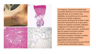 A su ingreso, el paciente también tenía
una lesión dolorosa en cara interna del pie
izquierdo que, en un examen más
detallado, se encontró que era una placa
violácea con bordes irregulares.
Una muestra de biopsia de la lesión a bajo
aumento mostró piel acral en gran parte
intacta con espacios vasculares dilatados
y dispersos en la dermis superficial y
profunda a mayor aumento, se descubrió
que los espacios vasculares estaban
estrechamente asociados con las
estructuras anexiales normales y estaban
revestidos por células endoteliales
agujereadas hipercromáticas.
La tinción inmunohistoquímica para HHV-8
reveló células endoteliales atípicas
 