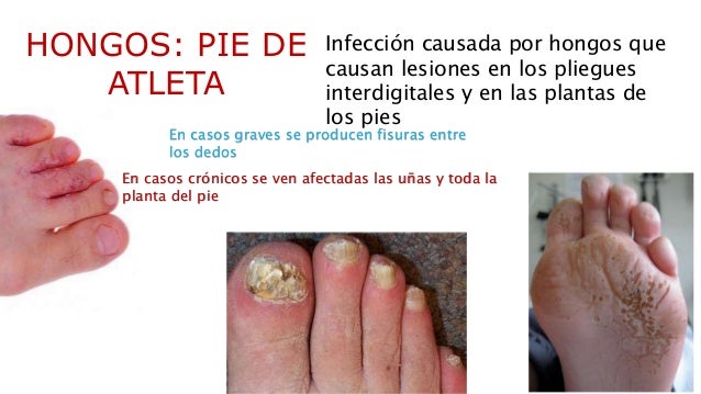 El hongo de las uñas a los niños el médico