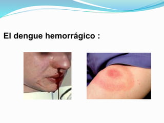 El dengue hemorrágico :
 