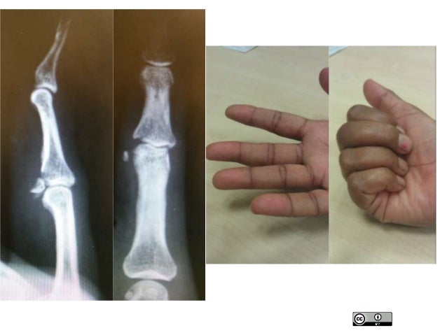 Elderly hand fractures singapore 2015 rauma conference v2.0