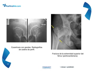 10
Coxartrosis con geodas. Radiografías
de cadera de perfil.
Fractura de la extremidad superior del
fémur (pertrocanteriana).
 