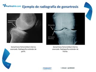 11
Gonartrosis femorotibial interna
avanzada. Radiografía estándar de
perfil.
Ejemplo de radiografía de gonartrosis
Gonartrosis femorotibial interna
avanzada. Radiografía estándar de
frente.
 