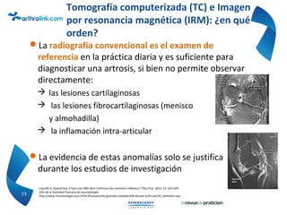 Tomografía computerizada (TC) e Imagen
por resonancia magnética (IRM): ¿en qué
orden?
La radiografía convencional es el examen de
referencia en la práctica diaria y es suficiente para
diagnosticar una artrosis, si bien no permite observar
directamente:
 las lesiones cartilaginosas
 las lesiones fibrocartilaginosas (menisco
y almohadilla)
 la inflamación intra-articular
La evidencia de estas anomalías solo se justifica
durante los estudios de investigación
13
Loeuille D. Quand faut-il faire une IRM dans l’arthrose des membres inférieurs ? Rev Prat. 2012; 62: 625-629
Sitio de la Sociedad Francesa de reumatología:
http://www.rhumatologie.asso.fr/04-Rhumatismes/grandes-maladies/0B-dossier-arthrose/A0_definition.asp
 