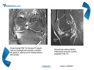 14
Corte frontal FSE T2 Artrosis FT lesión
interna cartilaginosa meseta y cóndilo
de grado 4, edema de la meseta tibial y
del cóndilo.
Gonartrosis edema tibial e
inflamación sinovial. Cortes
sagitales FSE T2.
 