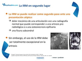 La IRM en segundo lugar
 La IRM se puede realizar como segundo paso ante una
presentación atípica:
 dolor mecánico de una articulación con una radiografía
normal que puede corresponder a una artrosis pre-
radiológica o a una osteonecrosis epifisaria
 una fisura subcondral
 Sin embargo, el uso de la IRM debe
ser totalmente excepcional en la
artrosis
15 Chevalier X. Arthrose du genou et de la hanche. Rev Prat Med Gen. 2007; 21: 987-991
Loeuille D. Quand faut-il faire une IRM dans l’arthrose des membres inférieurs ? Rev Prat. 2012 ; 62 : 625-629
 