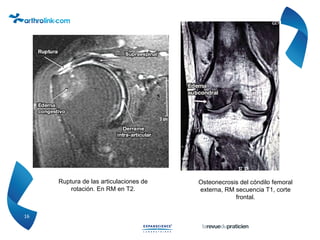 16
Ruptura de las articulaciones de
rotación. En RM en T2.
Osteonecrosis del cóndilo femoral
externa, RM secuencia T1, corte
frontal.
 