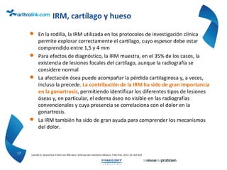 IRM, cartílago y hueso
 En la rodilla, la IRM utilizada en los protocolos de investigación clínica
permite explorar correctamente el cartílago, cuyo espesor debe estar
comprendido entre 1,5 y 4 mm
 Para efectos de diagnóstico, la IRM muestra, en el 35% de los casos, la
existencia de lesiones focales del cartílago, aunque la radiografía se
considere normal
 La afectación ósea puede acompañar la pérdida cartilaginosa y, a veces,
incluso la precede. La contribución de la IRM ha sido de gran importancia
en la gonartrosis, permitiendo identificar los diferentes tipos de lesiones
óseas y, en particular, el edema óseo no visible en las radiografías
convencionales y cuya presencia se correlaciona con el dolor en la
gonartrosis.
 La IRM también ha sido de gran ayuda para comprender los mecanismos
del dolor.
17 Loeuille D. Quand faut-il faire une IRM dans l’arthrose des membres inférieurs ? Rev Prat. 2012; 62: 625-629
 