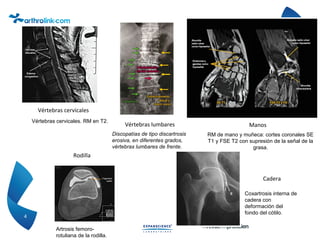 4
Vértebras cervicales
Vértebras lumbares Manos
Rodilla
Cadera
Vértebras cervicales. RM en T2.
Discopatías de tipo discartrosis
erosiva, en diferentes grados,
vértebras lumbares de frente.
RM de mano y muñeca: cortes coronales SE
T1 y FSE T2 con supresión de la señal de la
grasa.
Artrosis femoro-
rotuliana de la rodilla.
Coxartrosis interna de
cadera con
deformación del
fondo del cótilo.
 