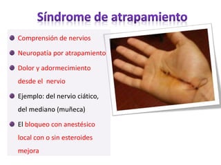 Comprensión de nervios
Neuropatía por atrapamiento
Dolor y adormecimiento
desde el nervio
Ejemplo: del nervio ciático,
del mediano (muñeca)
El bloqueo con anestésico
local con o sin esteroides
mejora
 
