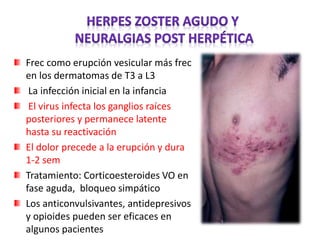 Frec como erupción vesicular más frec
en los dermatomas de T3 a L3
La infección inicial en la infancia
El virus infecta los ganglios raíces
posteriores y permanece latente
hasta su reactivación
El dolor precede a la erupción y dura
1-2 sem
Tratamiento: Corticoesteroides VO en
fase aguda, bloqueo simpático
Los anticonvulsivantes, antidepresivos
y opioides pueden ser eficaces en
algunos pacientes
 
