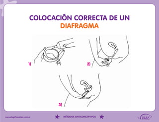 COLOCACIÓN CORRECTA DE UN
                               DIAFRAGMA




                      1)                            2)




                               3)

www.elegirhacebien.com.ar           MÉTODOS ANTICONCEPTIVOS
 