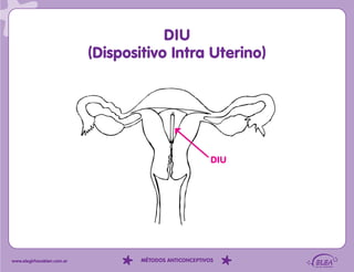 DIU
                            (Dispositivo Intra Uterino)




                                                          DIU




www.elegirhacebien.com.ar           MÉTODOS ANTICONCEPTIVOS
 